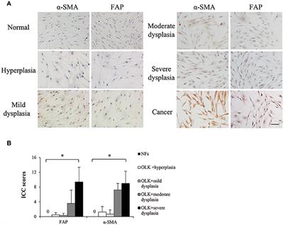 Reduced CX3CL1 Secretion Contributes to the Susceptibility of Oral Leukoplakia-Associated Fibroblasts to Candida albicans